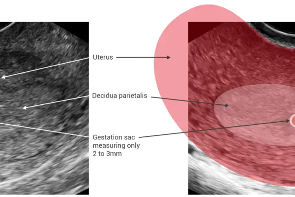 Gestation sac - medical illustration