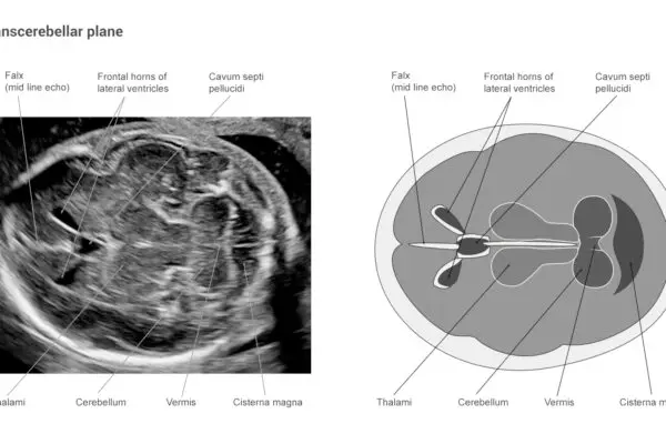 Transcerebellar plane - medical illustration