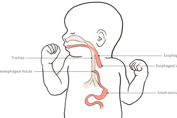 Esophageal atresia - medical illustration